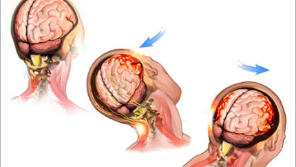 Concussion, Brain Injury