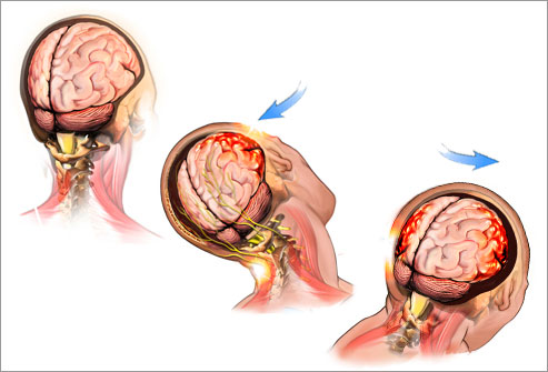 Concussion, Brain Injury